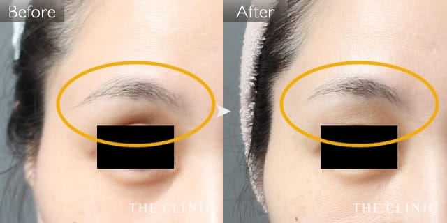 症例写真 / マイクロCRF注入(顔の脂肪注入) 術前・術後