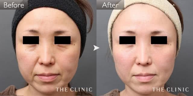 症例写真 / マイクロCRF注入(顔の脂肪注入) 術前・術後