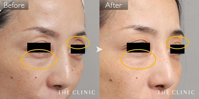 症例写真 / マイクロCRF注入(顔の脂肪注入) 術前・術後