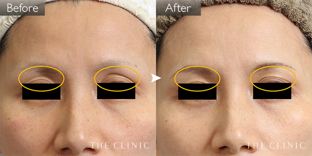 症例写真 / マイクロCRF注入(顔の脂肪注入) 術前・術後