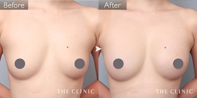 症例写真 / コンデンスリッチ豊胸 術前・術後