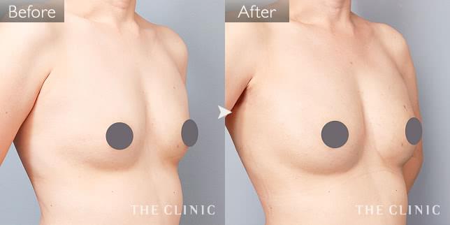 症例写真 / コンデンスリッチ豊胸 術前・術後