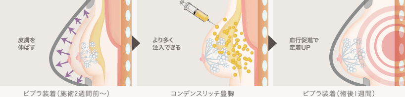 ビブラ装着（施術2週間前〜）: 皮膚を伸ばす / コンデンスリッチ豊胸: より多く注入できる / ビブラ装着（術後1週間）: 血行促進で定着UP