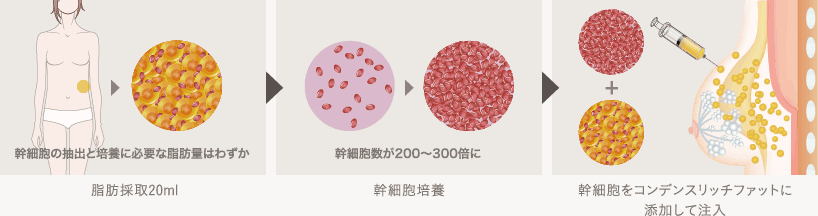 脂肪採取20ml: 幹細胞の抽出と培養に必要な脂肪量はわずか / 幹細胞培養: 幹細胞数が200〜300倍に / 幹細胞をコンデンスリッチファットに添加して注入
