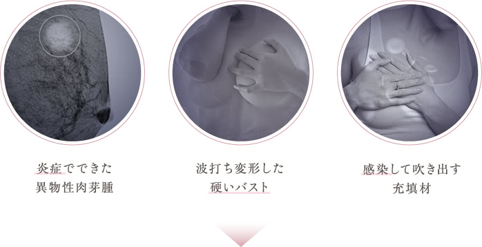 炎症でできた異物性肉芽腫 / 波打ち変形した硬いバスト / 感染して吹き出す充填材