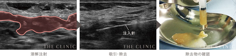 溶解注射 | 吸引・除去: 注入針 | 除去物の確認