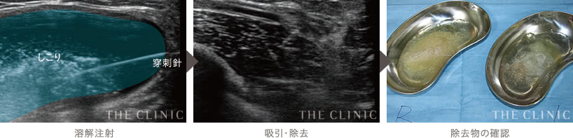 溶解注射: しこり 穿刺針 | 吸引・除去 | 除去物の確認