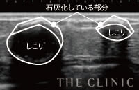 石灰化したしこりのエコー画像：しこりの周囲をカルシウムの結晶が覆っている。