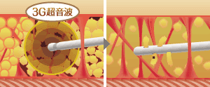 ベイザー脂肪吸引の作用メカニズム