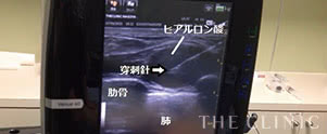 ヒアルロン酸しこり除去手術中のエコー画像