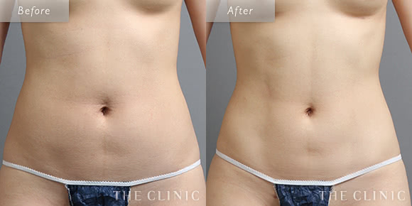 症例写真 / ベイザー4Dリポ 術前・術後