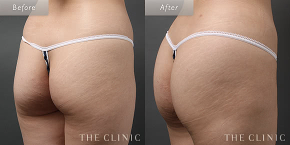 症例写真 / ベイザー4Dリポ 術前・術後