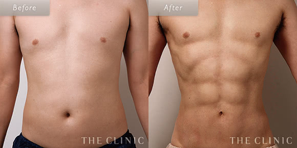 症例写真 / 4Dスカルプト 術前・術後