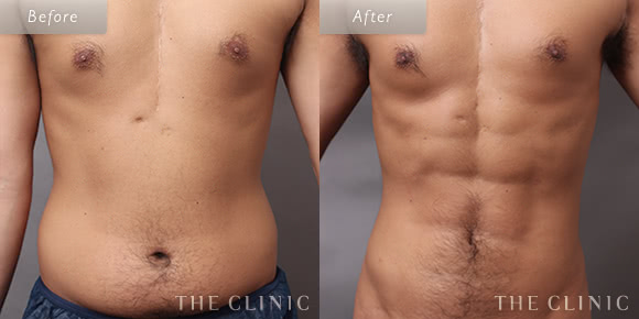 症例写真 / 4Dスカルプト 術前・術後