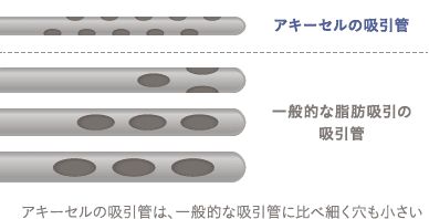 アキーセルの吸引管は、一般的な吸引管に比べ細く穴も小さい