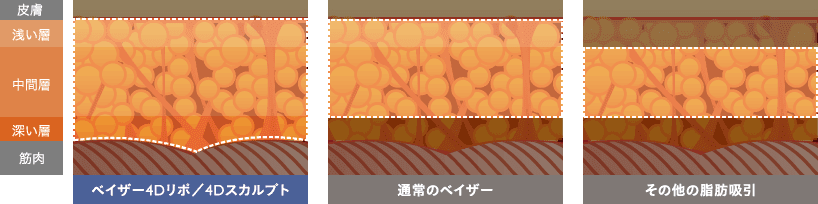ベイザー4Dリポ／4Dスカルプト / 通常のベイザー / その他の脂肪吸  引