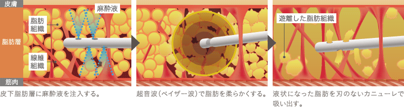 皮下脂肪層に麻酔液を注入する。 / 超音波（ベイザー波）で脂肪を柔らかくする。 / 液状になった脂肪を刃のないカニューレで吸い出す。