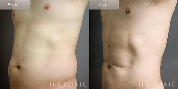 症例写真 / ベイザー4Dリポ 術前・術後