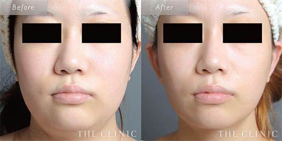 症例写真 / ベイザー脂肪吸引 術前・術後