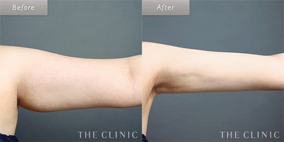 症例写真 / ベイザー脂肪吸引 術前・術後