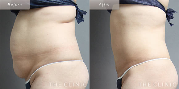 症例写真 / ベイザー脂肪吸引 術前・術後