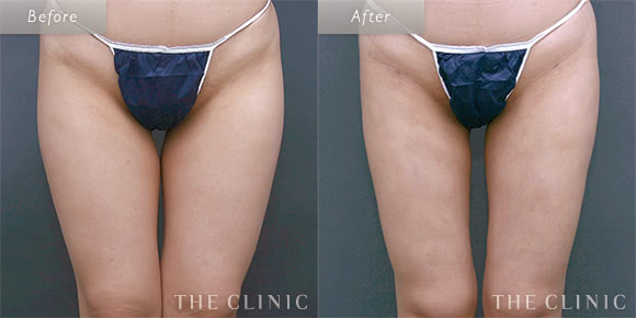 症例写真 / ベイザー脂肪吸引 術前・術後