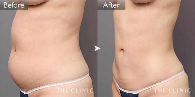 症例写真 / ベイザー脂肪吸引 術前・術後