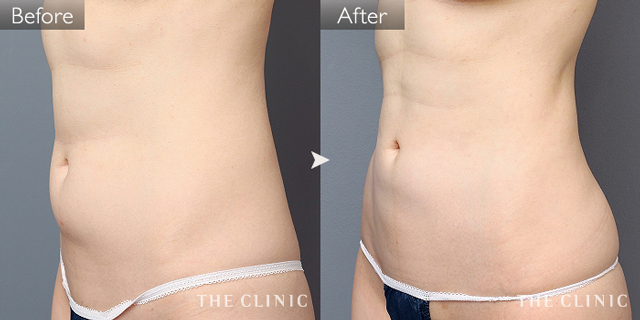 症例写真 / ベイザー脂肪吸引 術前・術後