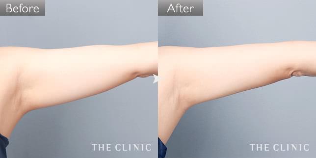 症例写真 / ベイザー脂肪吸引 術前・術後