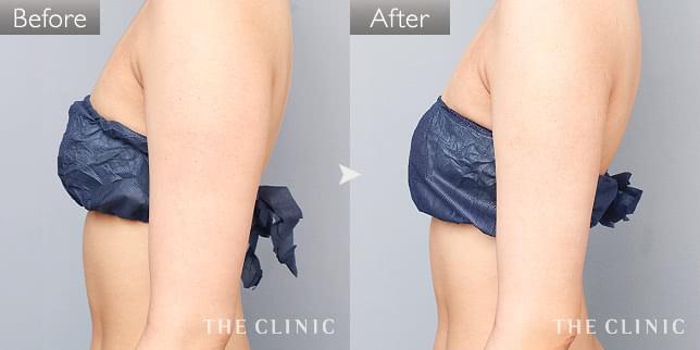症例写真 / ベイザー脂肪吸引 術前・術後