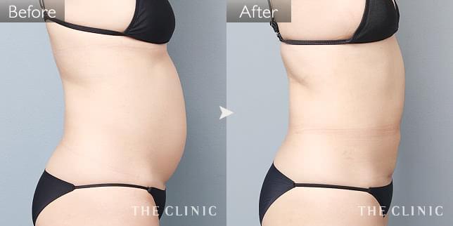 症例写真 / ベイザー脂肪吸引 術前・術後