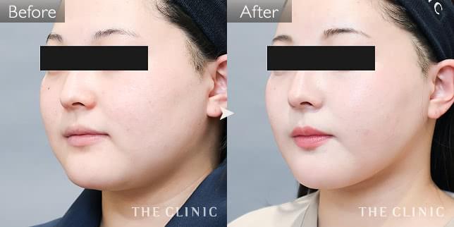 症例写真 / ベイザー脂肪吸引 術前・術後