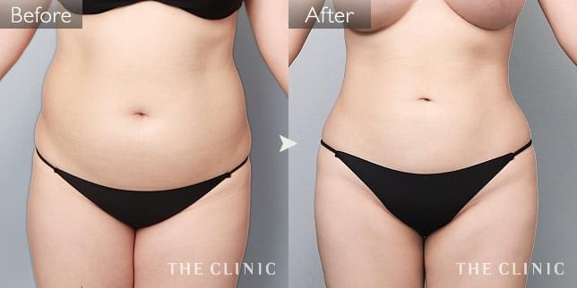 症例写真 / 360°脂肪吸引 術前・術後