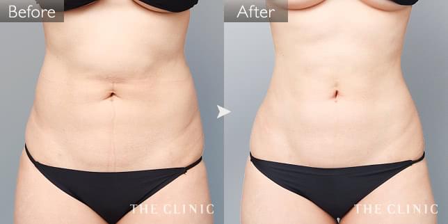症例写真 / 他院の脂肪吸引修正 術前・術後
