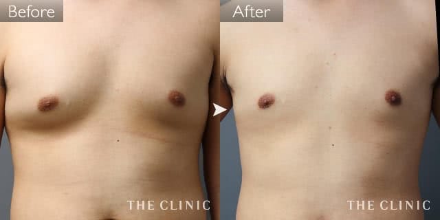 症例写真 / 女性化乳房治療(男性の胸の膨らみ改善) 術前・術後
