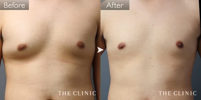 症例写真 / 女性化乳房治療(男性の胸の膨らみ改善) 術前・術後