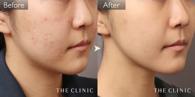 脂肪吸引 頰 顎 の症例写真 23歳 女性 東京院 The Clinic ザクリニック 美容外科 形成外科