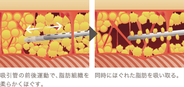 吸引管の前後運動で、脂肪組織を柔らかくほぐす。 / 同時にほぐれた脂肪を吸い取る。