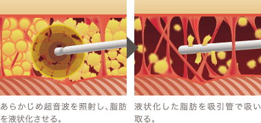 あらかじめ超音波を照射し、脂肪を液状化させる。 / 液状化した脂肪を吸引管で吸い取る。