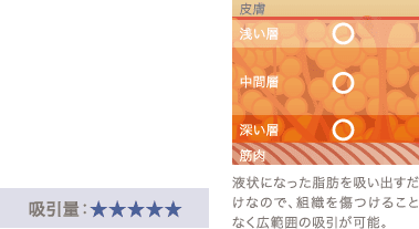 液状になった脂肪を吸い出すだけなので、組織を傷つけることなく広範囲の吸引が可能。 / 吸引量：★★★★★