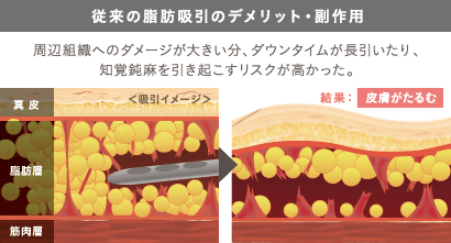 従来の脂肪吸引のデメリット・副作用: ＜吸引イメージ＞ / 結果：皮膚がたるむ