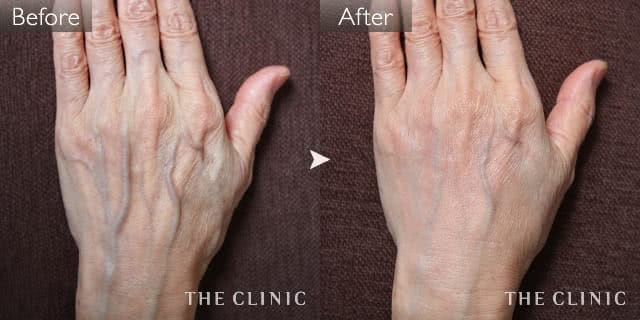 手のシワの手の甲への脂肪注入(ハンドリバイブ)症例写真（女性／65歳）-術前/術後