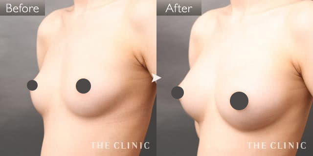 ボリュームアップのコンデンスリッチ豊胸(濃縮脂肪注入)症例写真（女性／20歳）-術前/術後