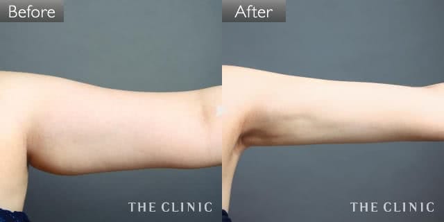 二の腕のベイザー脂肪吸引(ベイザーリポ)症例写真（女性／23歳）-術前/術後
