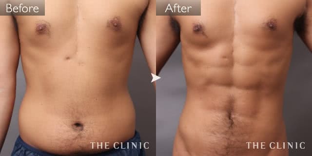 胸部のデザインのベイザー4D(シックスパック脂肪吸引)症例写真（男性／28歳）-術前/術後