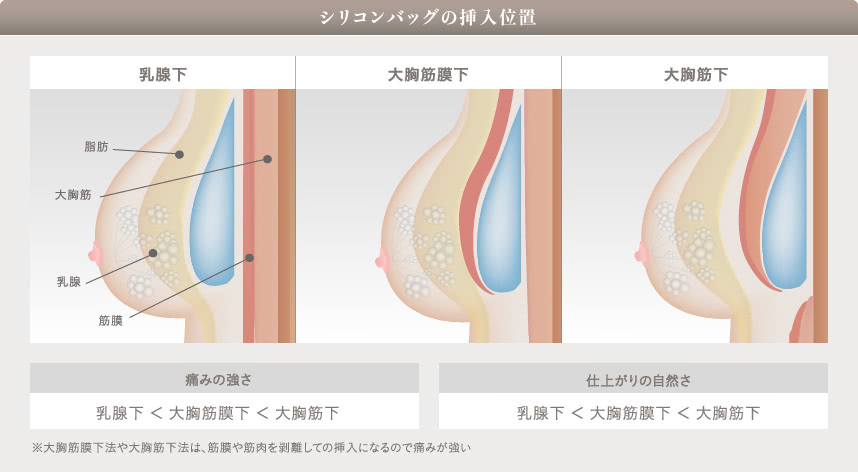 挿入位置によって変わるシリコンバッグ豊胸の痛みについて