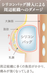 シリコンバッグ豊胸の大きさによって変わる痛み
