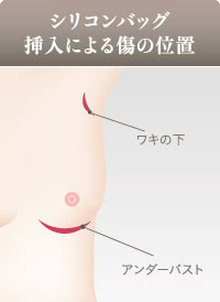 シリコンバッグ豊胸でできる傷跡