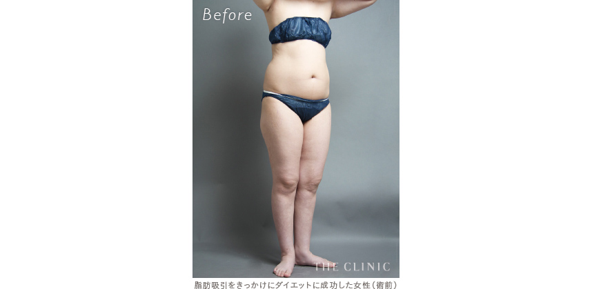 脂肪吸引をきっかけにダイエットに成功した症例（ビフォー）