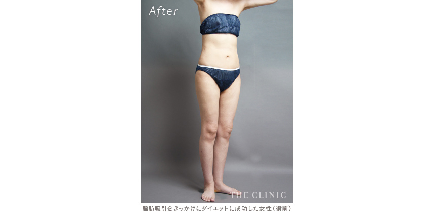 脂肪吸引をきっかけにダイエットに成功した症例（アフター）